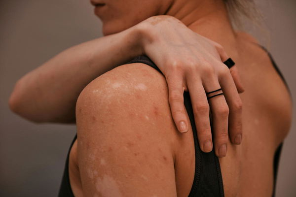 Eczema Rates by Country