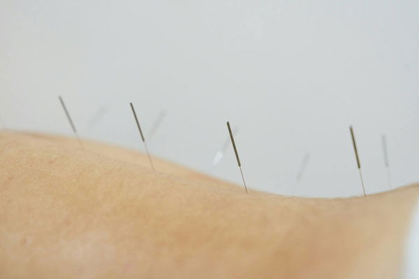 Dry Needling Legal States